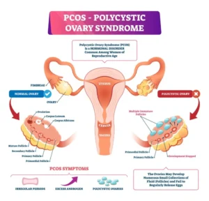 Homeopathic Treatment for Polycystic Ovarian Syndrome (PCOS)