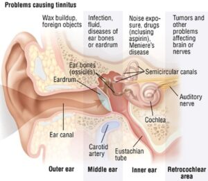 Homeopathy Treatment for Tinitus - Noise in the Ear