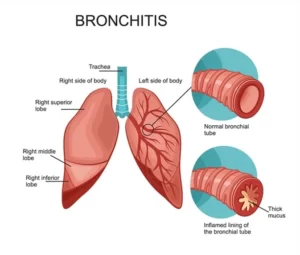 What is Bronchitis