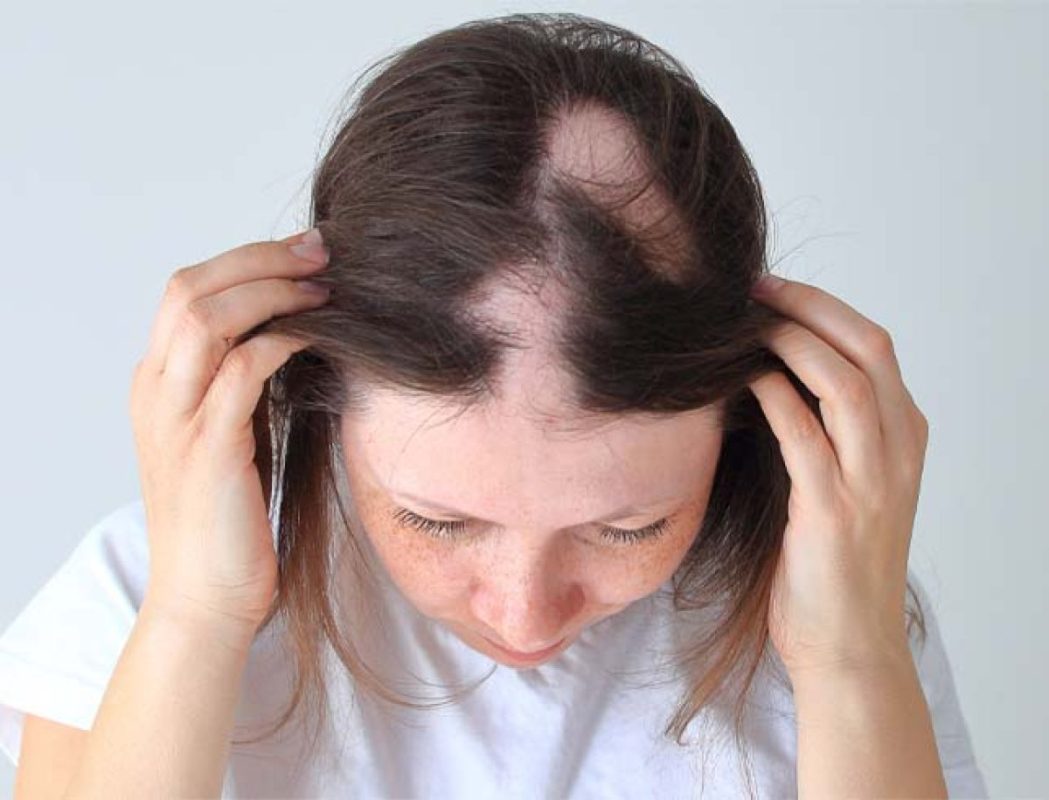 Homeopathic Treatments for Alopecia