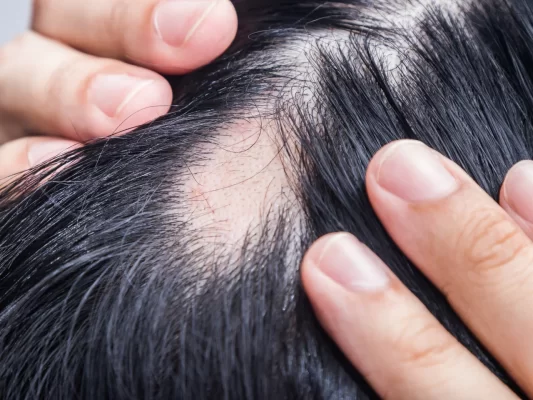 Homeopathic Treatments for Alopecia