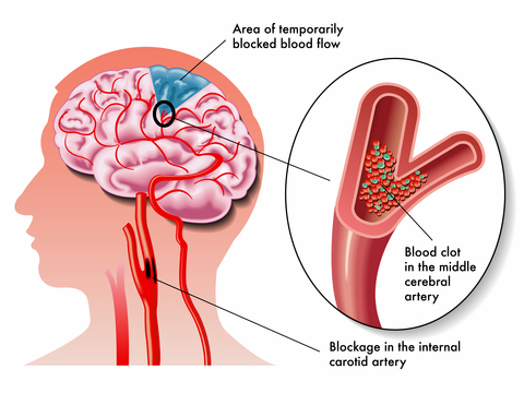 Homeopathic Treatments for Apoplexy