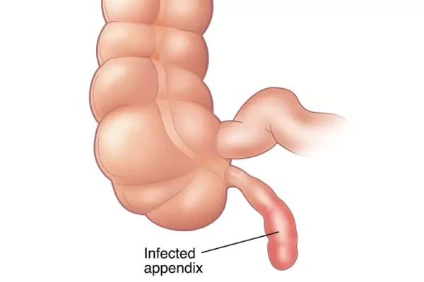 Homeopathic Treatments for Appendicitis