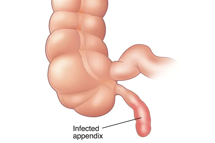 Homeopathic Treatments for Appendicitis