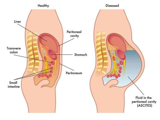Homeopathic Treatments for Ascites