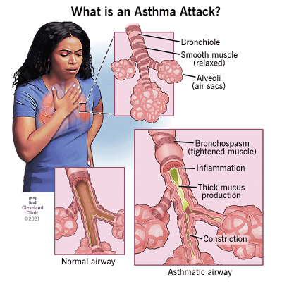 Homeopathic Treatments for Asthma