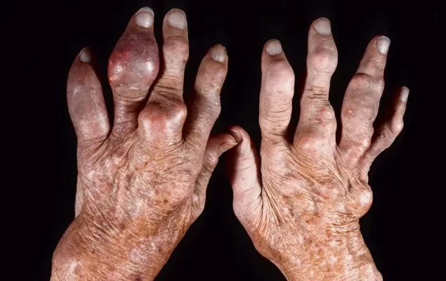 Homeopathic Treatments for Gout