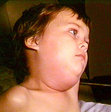 Homeopathic Treatment for Mumps