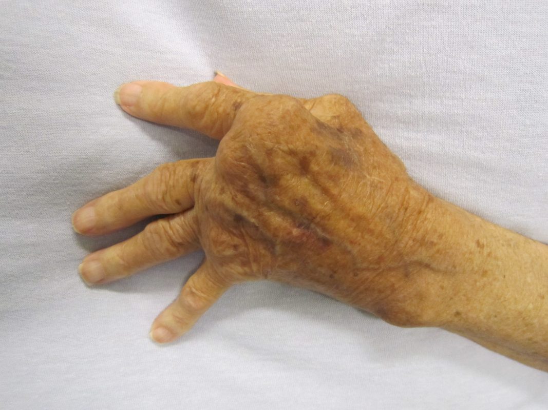 Homeopathic Treatments for Arthritis