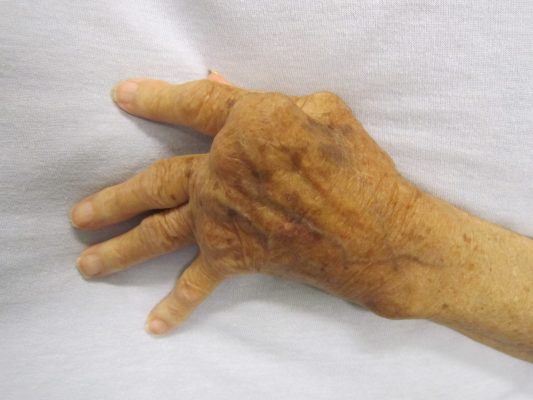 Homeopathic Treatments for Arthritis