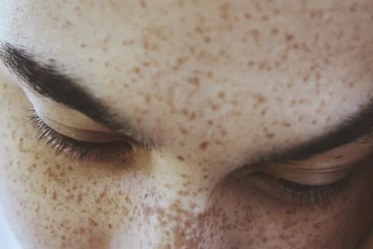 Homeopathic Medicine for Black Spots on Face