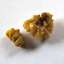 Homeopathic Treatments for Calculi (Stones)