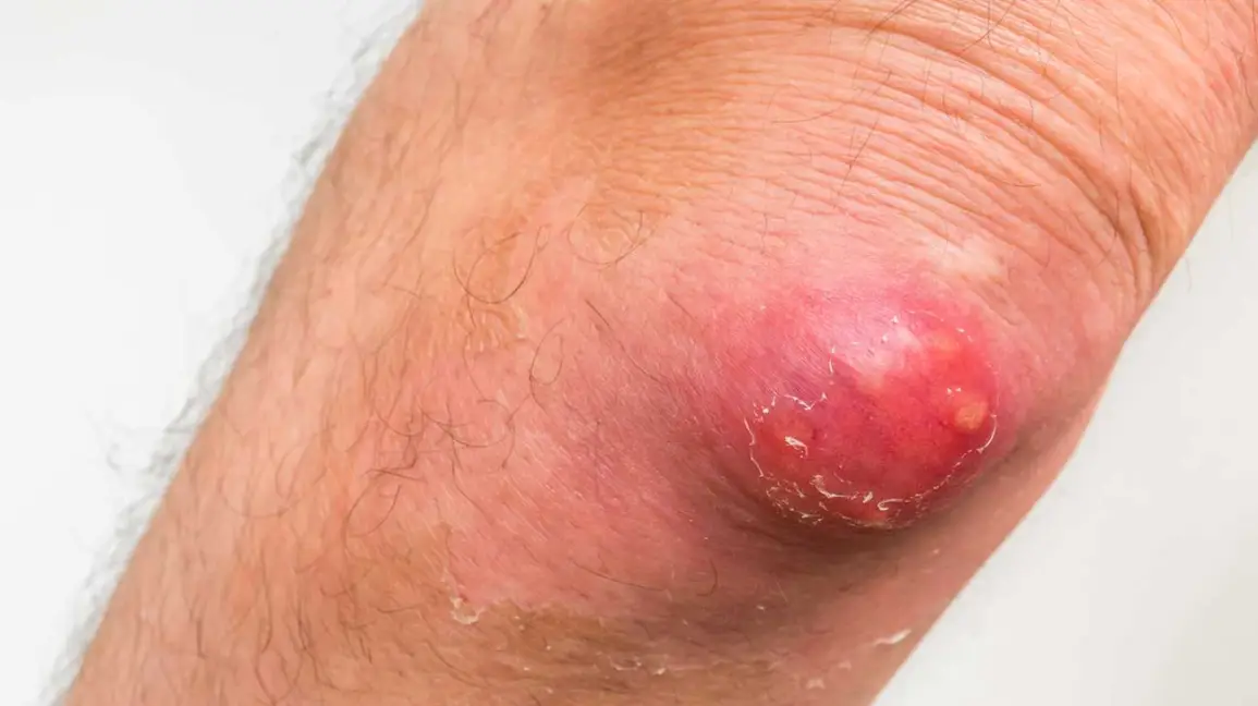 Homeopathic Treatments for Carbuncle