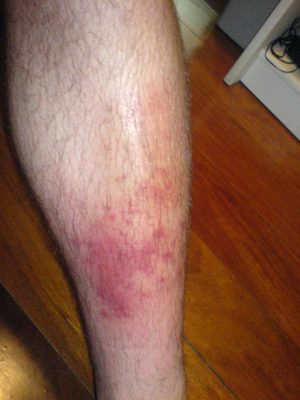 Homeopathic Treatments for Cellulitis