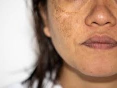 Homeopathic Treatments for Chloasma