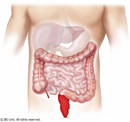 Homeopathic Treatments for Colitis
