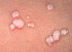 Homeopathic Treatments for Condylomata