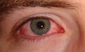Homeopathic Treatments for Conjunctivitis