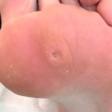 Homeopathic Treatments for Corns