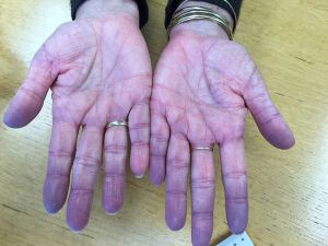 Homeopathic Treatments for Cyanosis