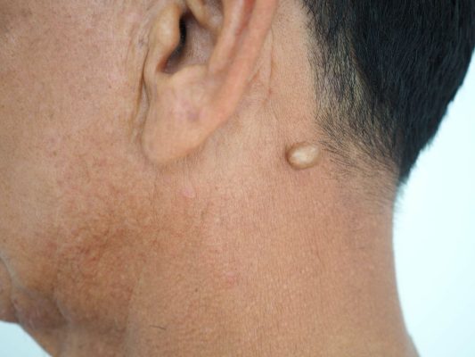 Homeopathic Treatments for Cysts