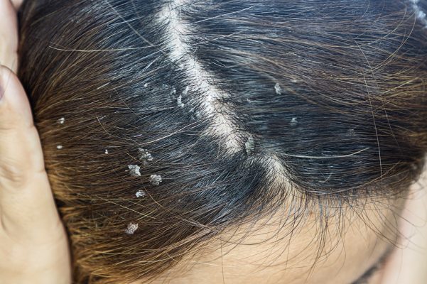 Remedy for Dandruff