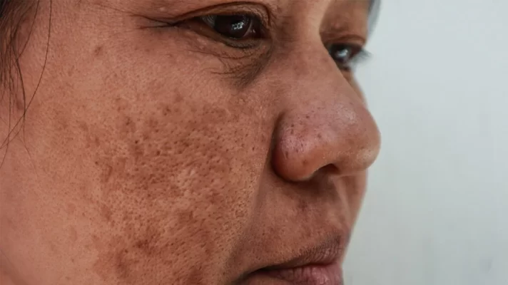 Homeopathic Treatments for Melasma