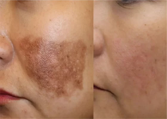 Homeopathic Medicine for Pigmentation