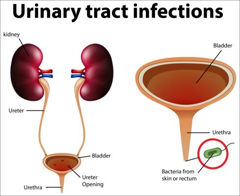 Homeopathic Treatments for Urinary Tract Infections (UTI)