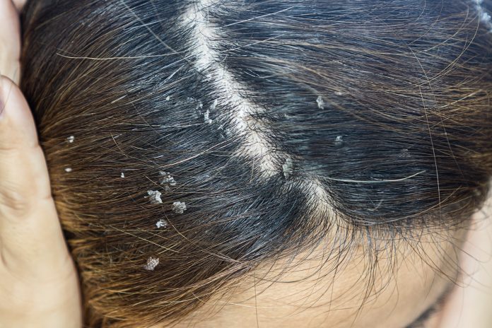Dandruff Best Homeopathic Remedy for Dandruff