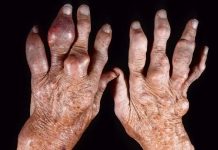 গেঁটে বাত বা গাউটের হোমিওপ্যাথিক চিকিৎসা